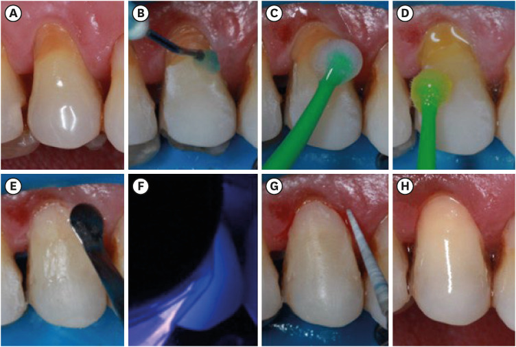 Epigallocatechin-3-gallate prior to composite resin in abfraction lesions: a split-mouth randomized clinical trial.