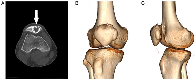 Osteoblastoma of the patella, a rare benign bone tumor with an uncommon site: A case report.