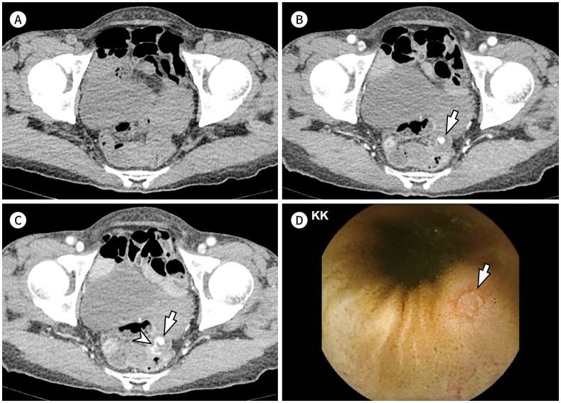 [Radiologic Diagnosis of Gastrointestinal Bleeding].