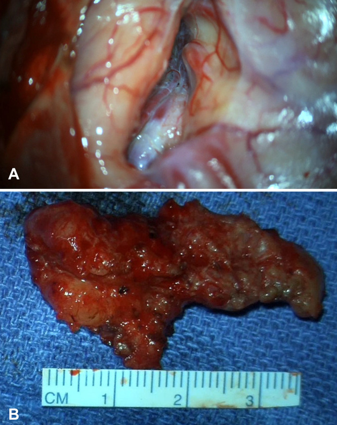Vascular anomaly, lipoma, and polymicrogyria associated with schizencephaly: developmental and diagnostic insights. Illustrative case.