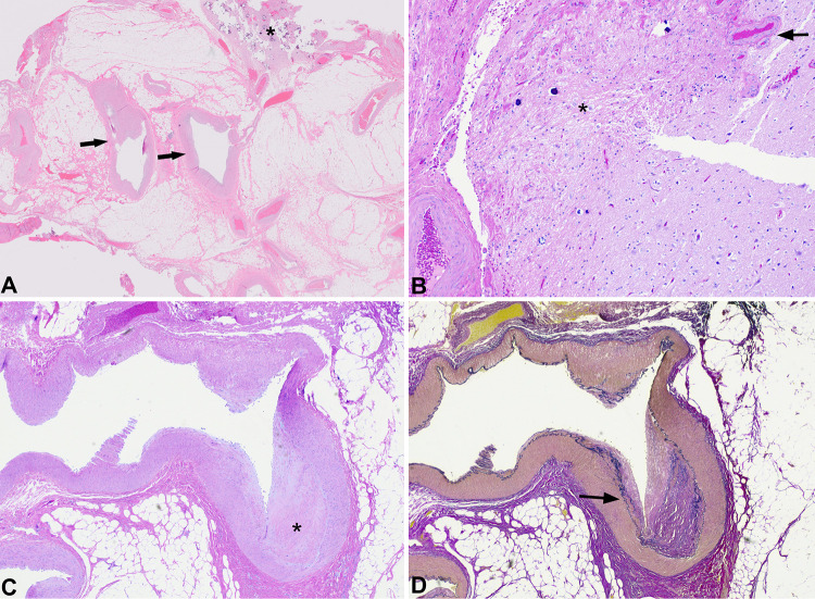 Vascular anomaly, lipoma, and polymicrogyria associated with schizencephaly: developmental and diagnostic insights. Illustrative case.