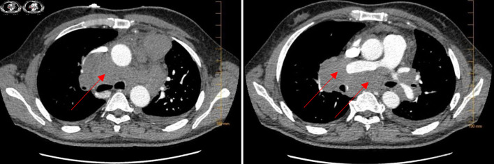 Vanishing Bile Duct Syndrome in a Patient With Recurrent Hodgkin Lymphoma.