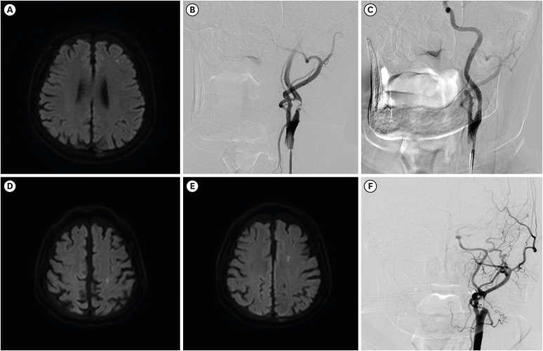 Low-Density Lipoprotein Cholesterol Levels Are Associated With Subsequent Stented-Territory Ischemic Stroke After Carotid Artery Stenting: A Single Center Retrospective Study.