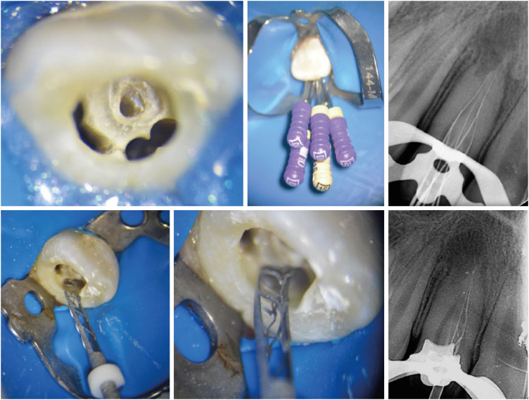 Successful nonsurgical treatment of type II dens invaginatus with 5 root canals using a self-adjusting file: a case report.