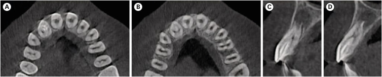 Successful nonsurgical treatment of type II dens invaginatus with 5 root canals using a self-adjusting file: a case report.