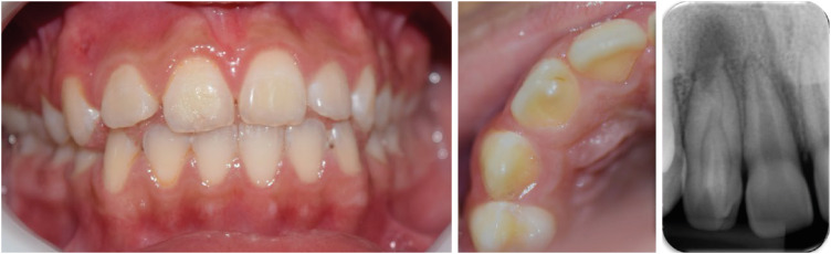 Successful nonsurgical treatment of type II dens invaginatus with 5 root canals using a self-adjusting file: a case report.