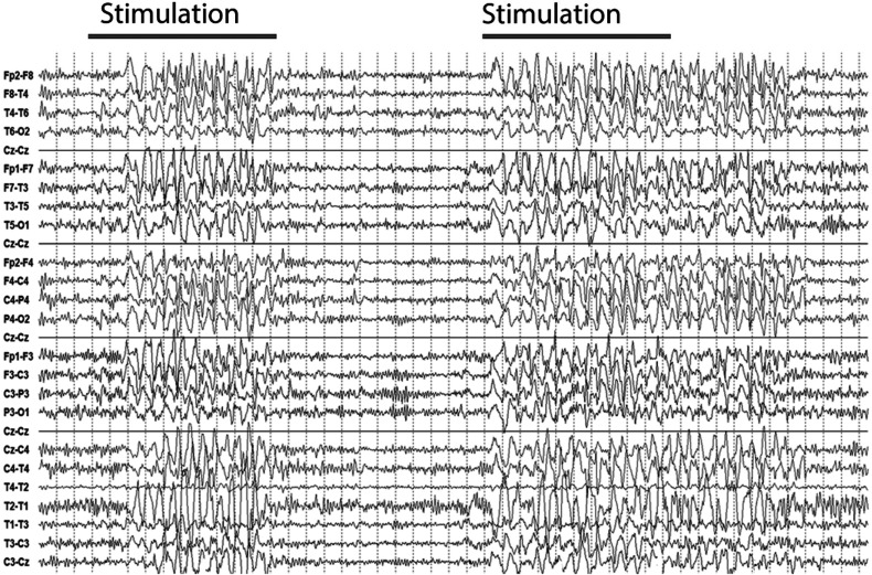 Stimulus Induced Rhythmic, Periodic, or Ictal Discharges (SIRPIDs) and its Association with Non-convulsive Status Epilepticus in Critically Ill Patients.