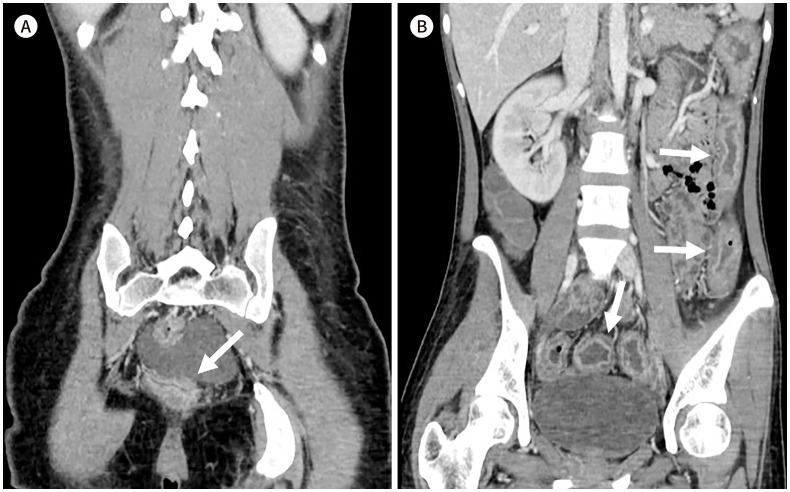 [Imaging Techniques and Differential Diagnosis for Inflammatory Bowel Disease].