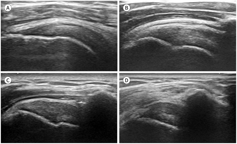 Effect of Patient's Positioning on the Grade of Tendinosis and Visible Range of Infraspinatus Tendon on Ultrasound.