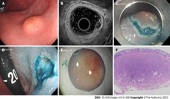 Rectal neuroendocrine tumours and the role of emerging endoscopic techniques.