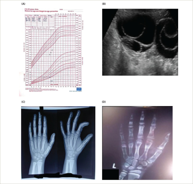 The Clinical Septet of Van Wyk-Grumbach Syndrome: A Case Series from a Tertiary Care Centre in Kalyana Karnataka, India.