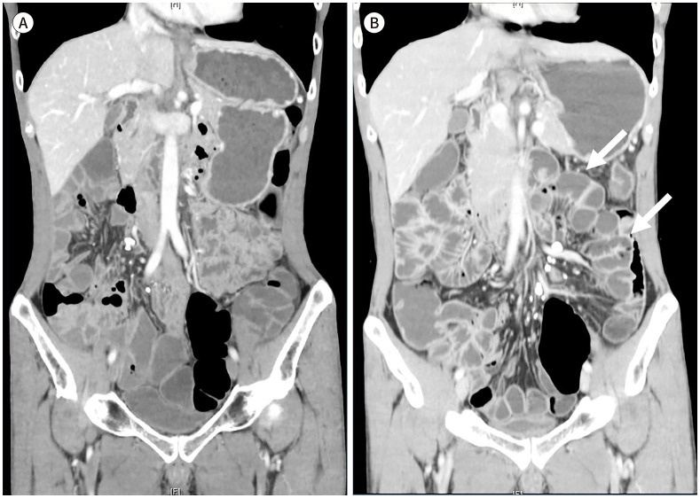 [Imaging Techniques and Differential Diagnosis for Inflammatory Bowel Disease].