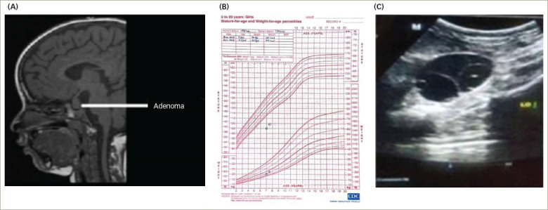 The Clinical Septet of Van Wyk-Grumbach Syndrome: A Case Series from a Tertiary Care Centre in Kalyana Karnataka, India.