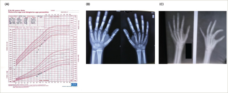 The Clinical Septet of Van Wyk-Grumbach Syndrome: A Case Series from a Tertiary Care Centre in Kalyana Karnataka, India.