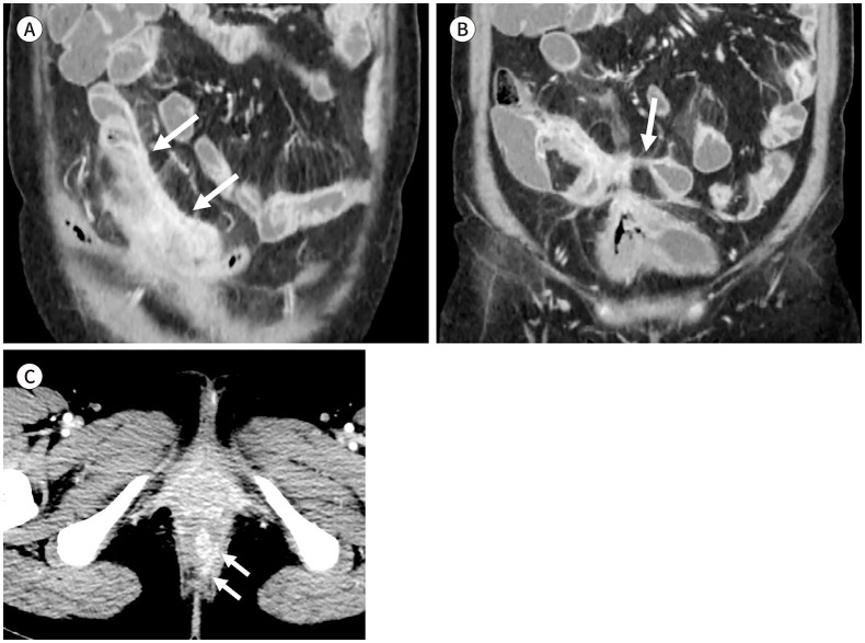 [Imaging Techniques and Differential Diagnosis for Inflammatory Bowel Disease].