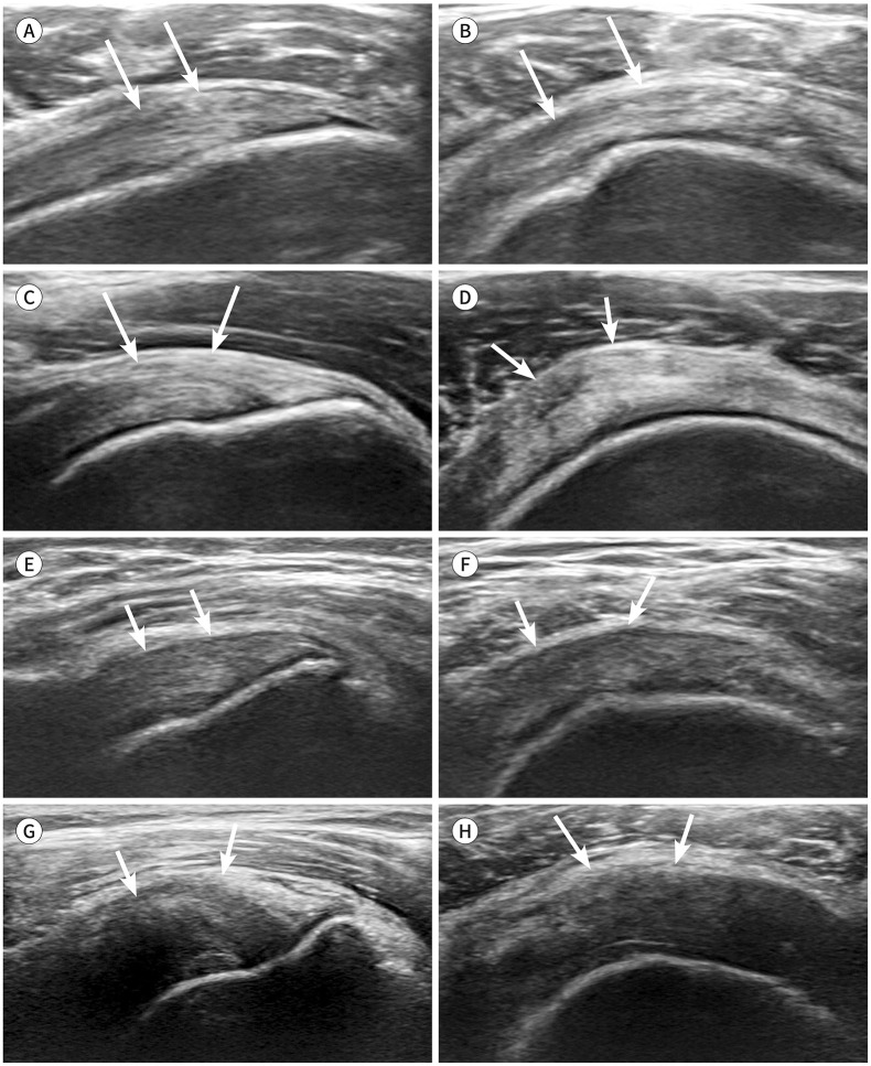 Effect of Patient's Positioning on the Grade of Tendinosis and Visible Range of Infraspinatus Tendon on Ultrasound.