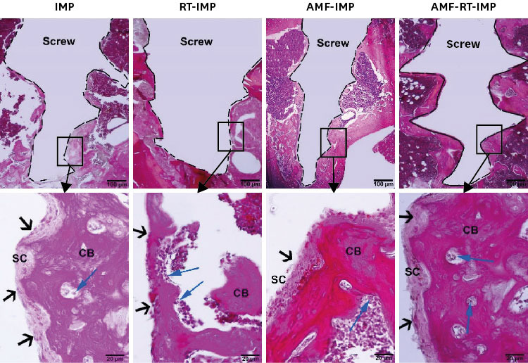 Radioprotective role of amifostine on osteointegration of titanium implants in the tibia of rats.