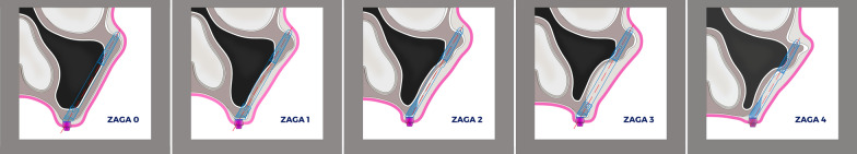 Evaluation of surgical techniques in survival rate and complications of zygomatic implants for the rehabilitation of the atrophic edentulous maxilla: a systematic review.