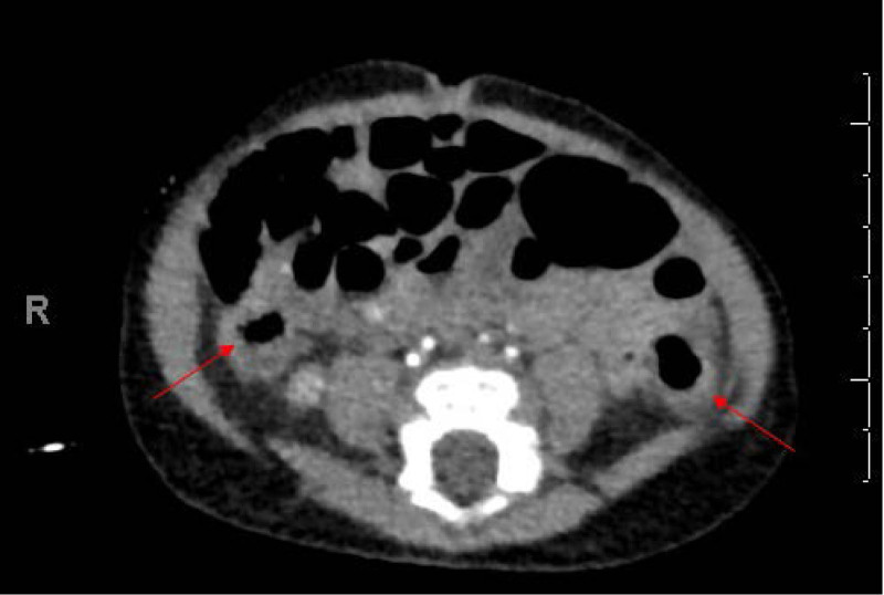 Endoscopy in a Pediatric Patient After Necrotizing Enterocolitis.