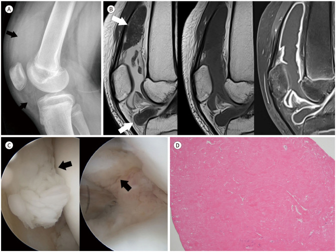 [Rice Bodies Presenting as Intra-Articular Masses in Pediatric Idiopathic Arthritis: A Case Report].