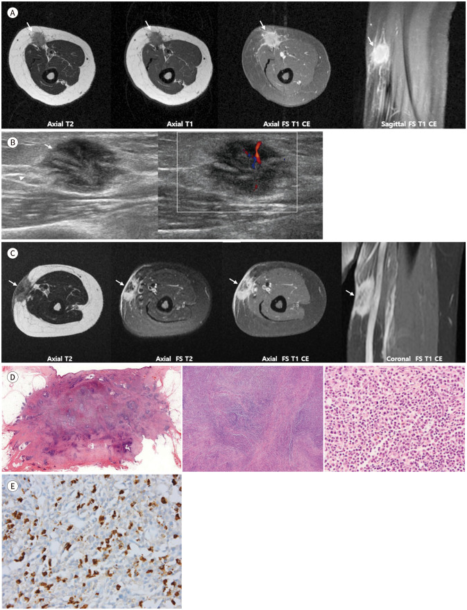 Unusual Manifestation of Immunoglobulin G4-Related Disease Involving the Upper Arm: A Case Report.