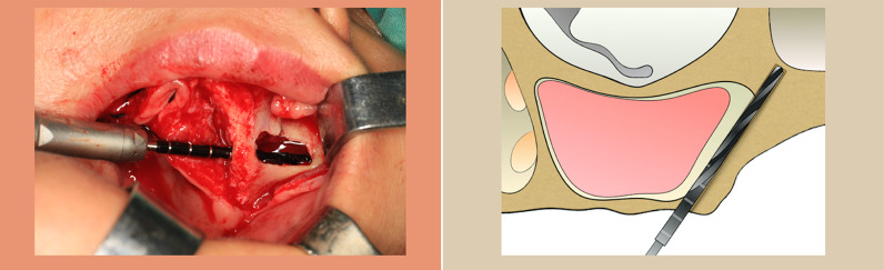 Evaluation of surgical techniques in survival rate and complications of zygomatic implants for the rehabilitation of the atrophic edentulous maxilla: a systematic review.