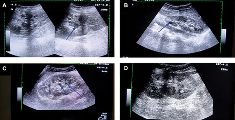 Congenital Hepatic Fibrosis as an Early Sign of Presentation of ADPKD.