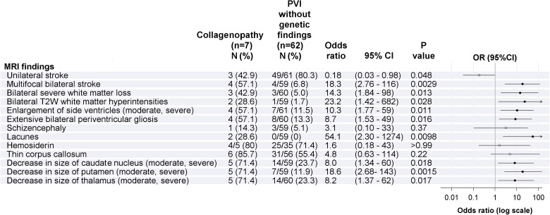 High Prevalence of Collagenopathies in Preterm- and Term-Born Children With Periventricular Venous Hemorrhagic Infarction.