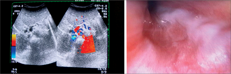 Congenital Hepatic Fibrosis as an Early Sign of Presentation of ADPKD.