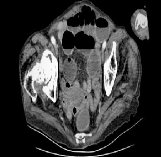 Incarcerated obturator hernia, an extremely rare cause of intestinal obstruction: case series.