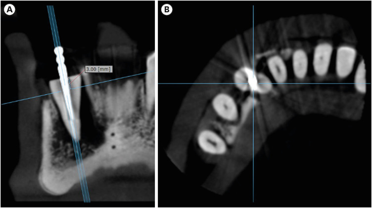 Influence of CBCT parameters on image quality and the diagnosis of vertical root fractures in teeth with metallic posts: an <i>ex vivo</i> study.