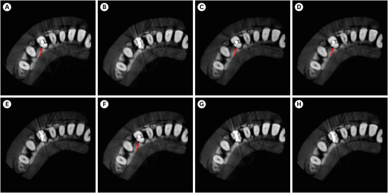 Influence of CBCT parameters on image quality and the diagnosis of vertical root fractures in teeth with metallic posts: an <i>ex vivo</i> study.