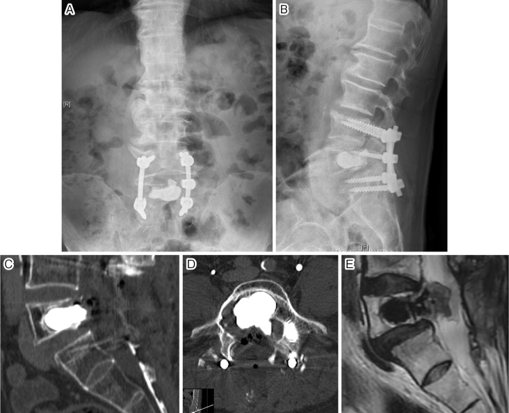 Intraosseous Aggressive Schwannoma in the Lumbar Spine: A Case Report.