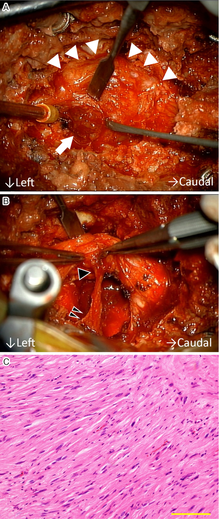 Intraosseous Aggressive Schwannoma in the Lumbar Spine: A Case Report.