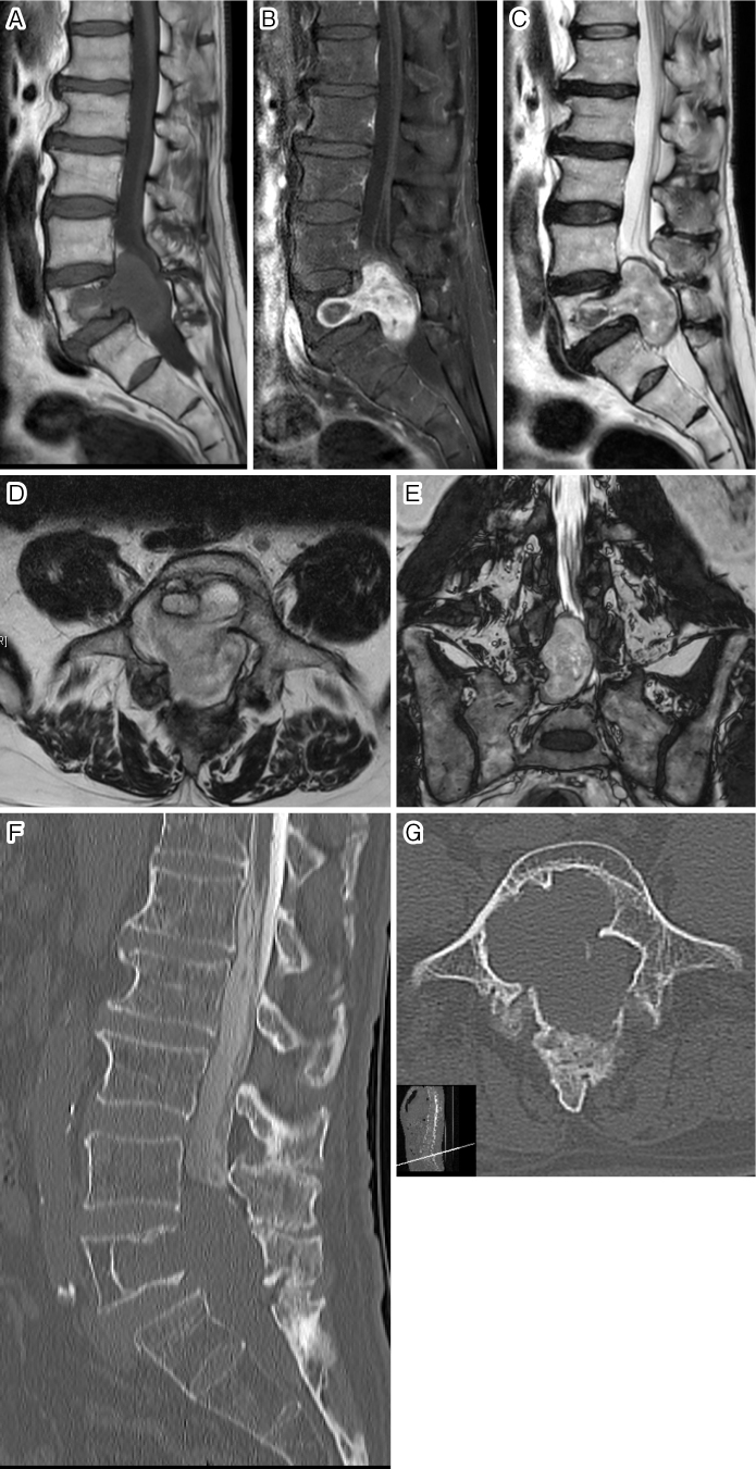 Intraosseous Aggressive Schwannoma in the Lumbar Spine: A Case Report.