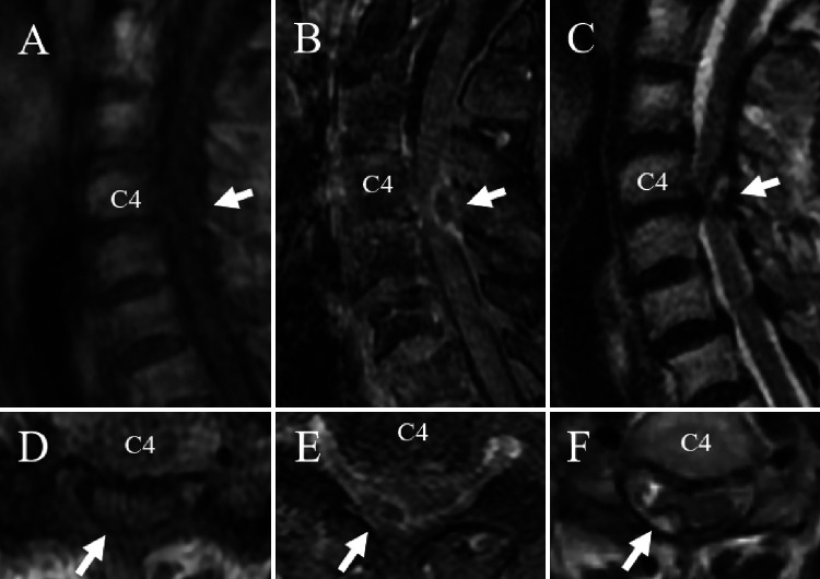 Hemorrhagic cervical juxta-facet cyst presenting with Brown-Séquard syndrome: illustrative case.