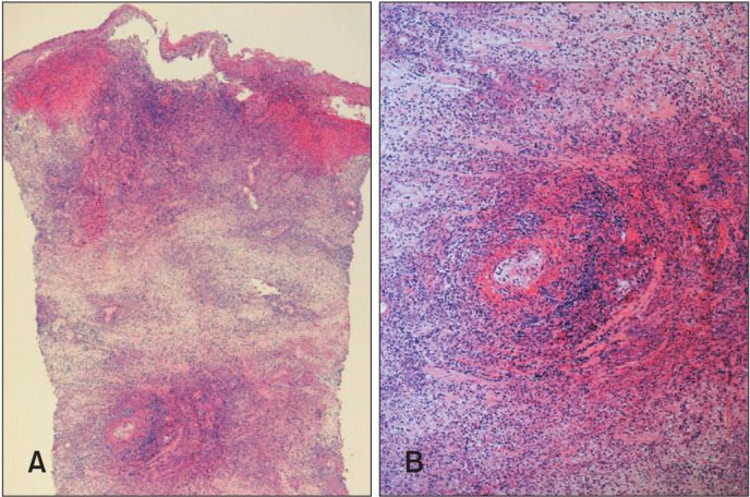 A Rare Case of Juvenile Gangrenous Vasculitis of the Scrotum in Korea.