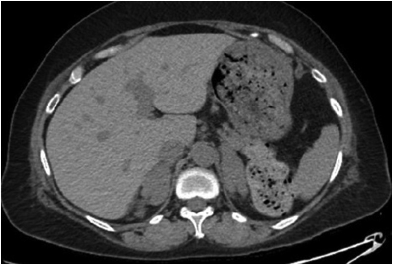 Stress-induced severe transient hypercortisolism with reversible bilateral adrenal enlargement after cardiogenic shock.