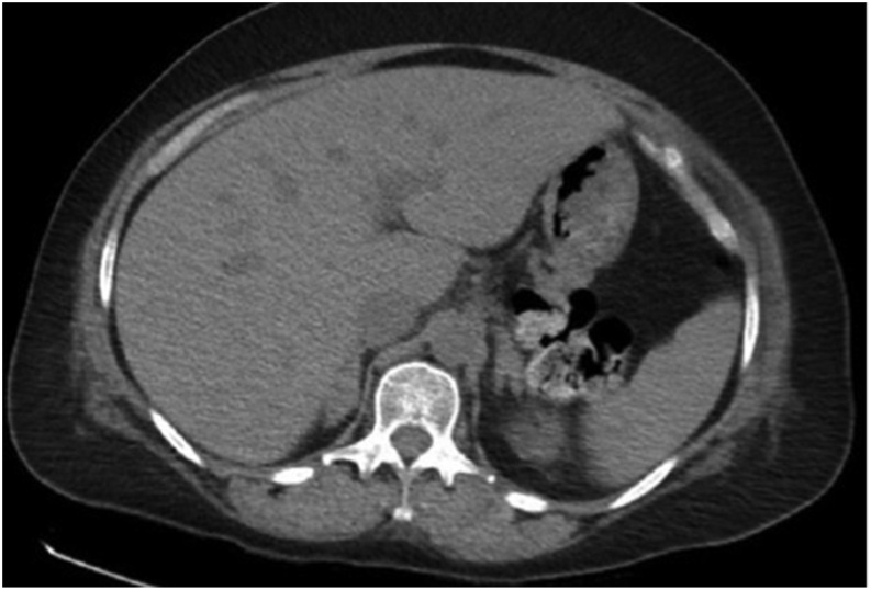 Stress-induced severe transient hypercortisolism with reversible bilateral adrenal enlargement after cardiogenic shock.