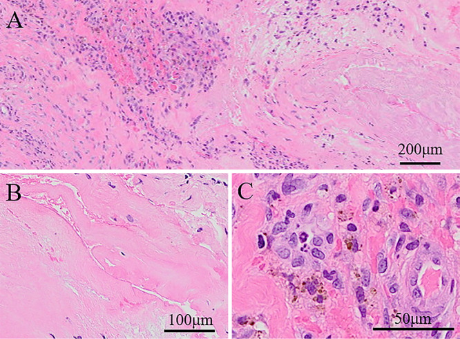 Hemorrhagic cervical juxta-facet cyst presenting with Brown-Séquard syndrome: illustrative case.