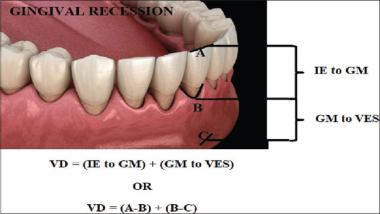 Estimation of vestibular depth: An observational cross-sectional study.