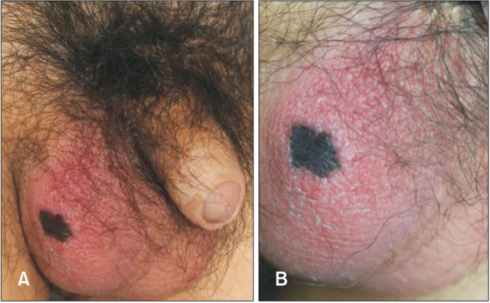 A Rare Case of Juvenile Gangrenous Vasculitis of the Scrotum in Korea.