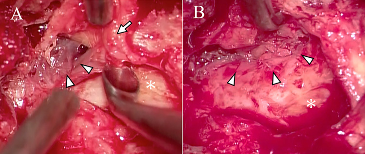 Hemorrhagic cervical juxta-facet cyst presenting with Brown-Séquard syndrome: illustrative case.
