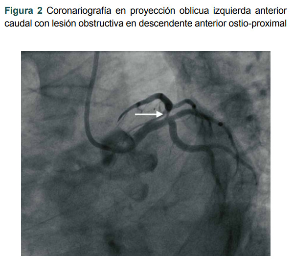 [Acute coronary syndrome provoked by a coronary intramural hematoma].