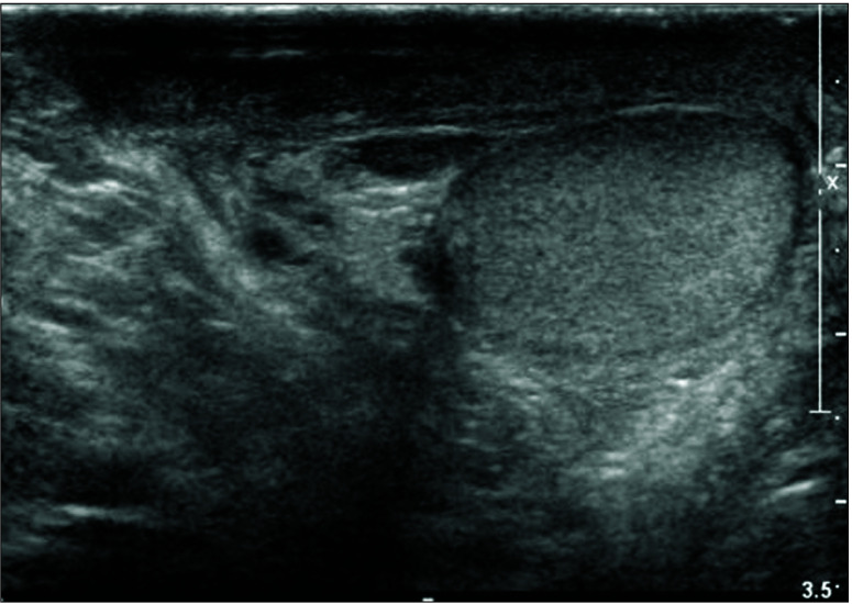 A Rare Case of Juvenile Gangrenous Vasculitis of the Scrotum in Korea.