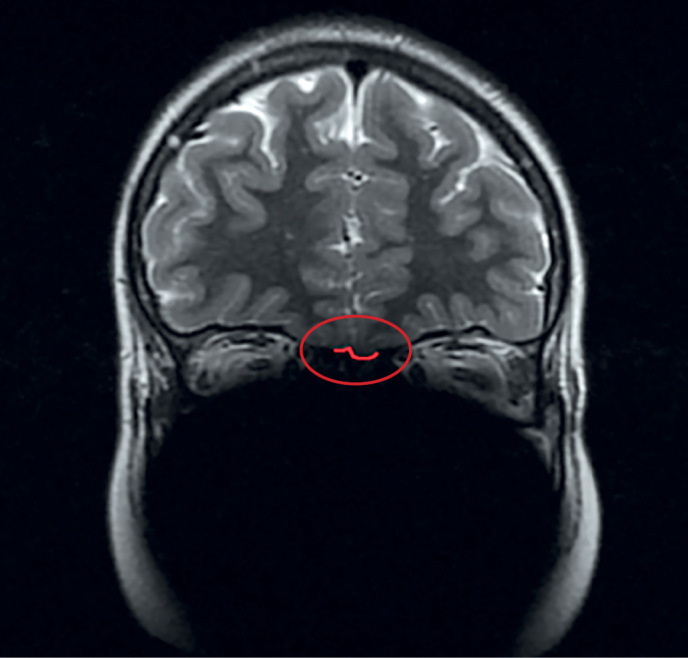 [Olfactory function and olfactory bulbs in patients with Kallmann syndrome].