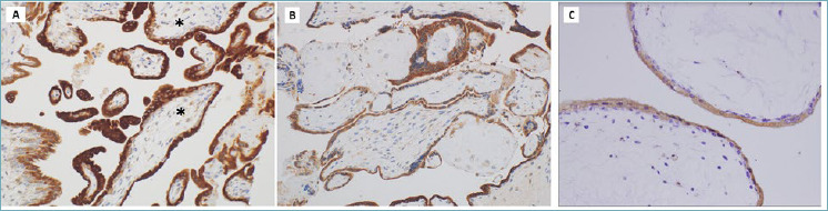 Immunohistochemical expression of BCL-2 in hydatidiform moles: a tissue microarray study.