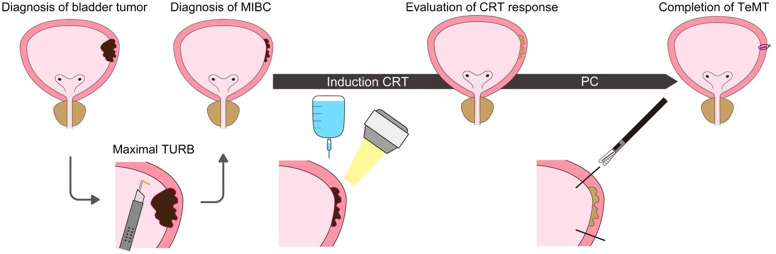 Preservation of Erectile and Ejaculatory Functions After Tetramodal Bladder-Sparing Therapy Incorporating Consolidative Partial Cystectomy Against Muscle Invasive Bladder Cancer.