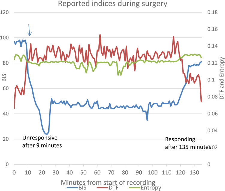 Monitoring the Awake and Anesthetized Unconscious States Using Bispectral Index and Electroencephalographic Connectivity Measures.