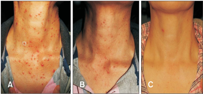 Successful Therapeutic Effect of 1,064-nm Nd:YAG Laser on Lupus Miliaris Disseminatus Faciei Solely on Neck.